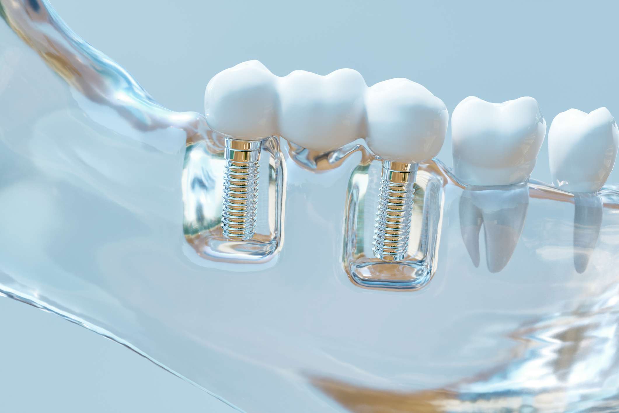 Taboola Ad Example 35089 - Протезирование Зубов Коронками – 3 Главных Преимущества